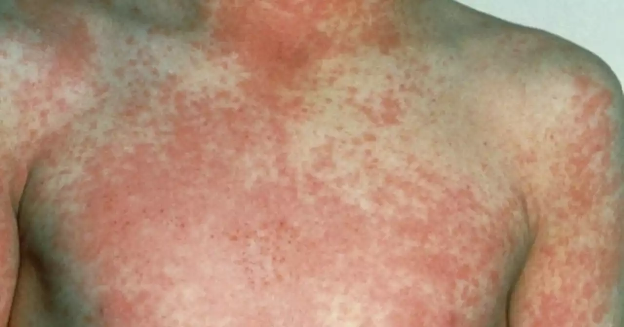 Scarlet fever warning issued for UK children - symptoms of Victorian disease