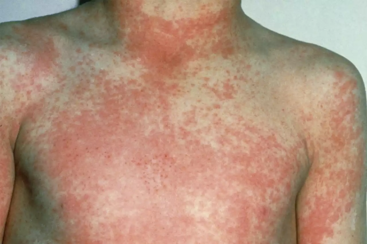 Urgent Scarlet Fever warning for UK - these are the symptoms to lookout for