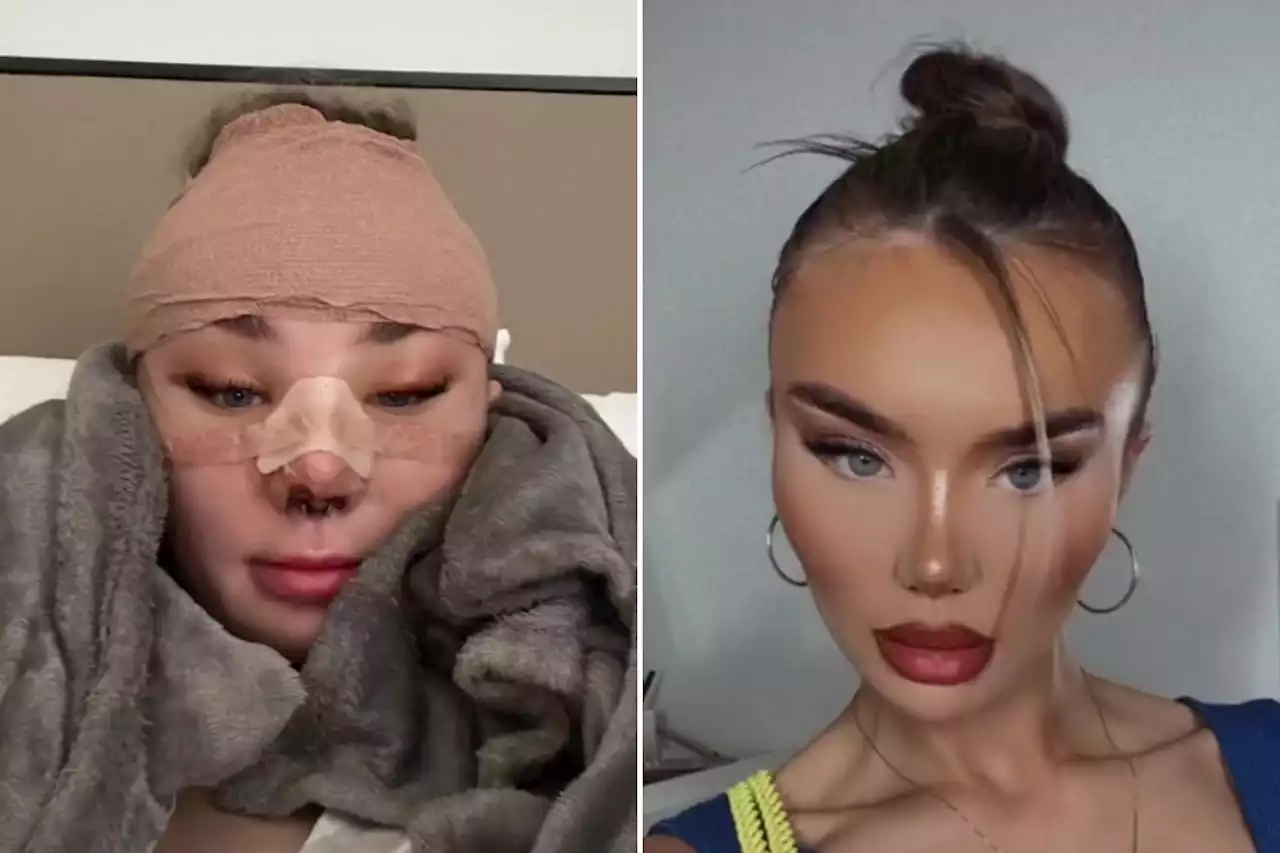 I got trolled for my big nose…now I’m bullied for having surgery to fix it