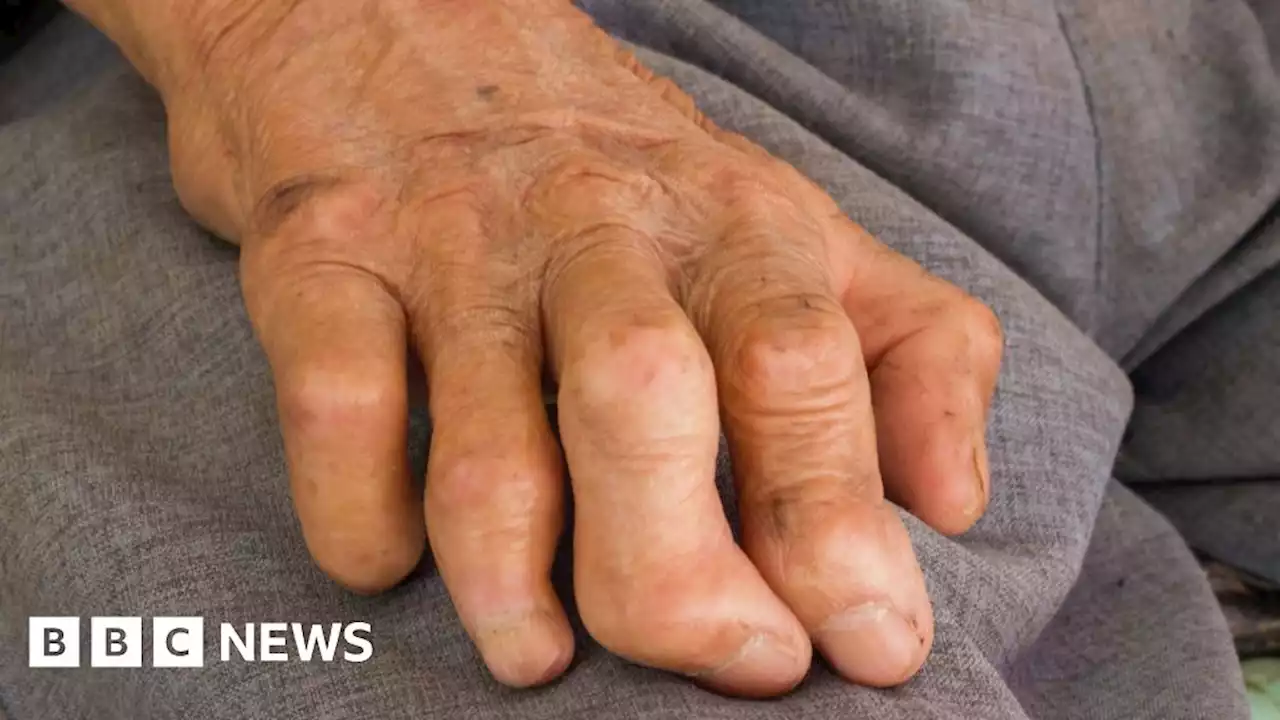 Leprosy: Ancient disease able to regenerate organs