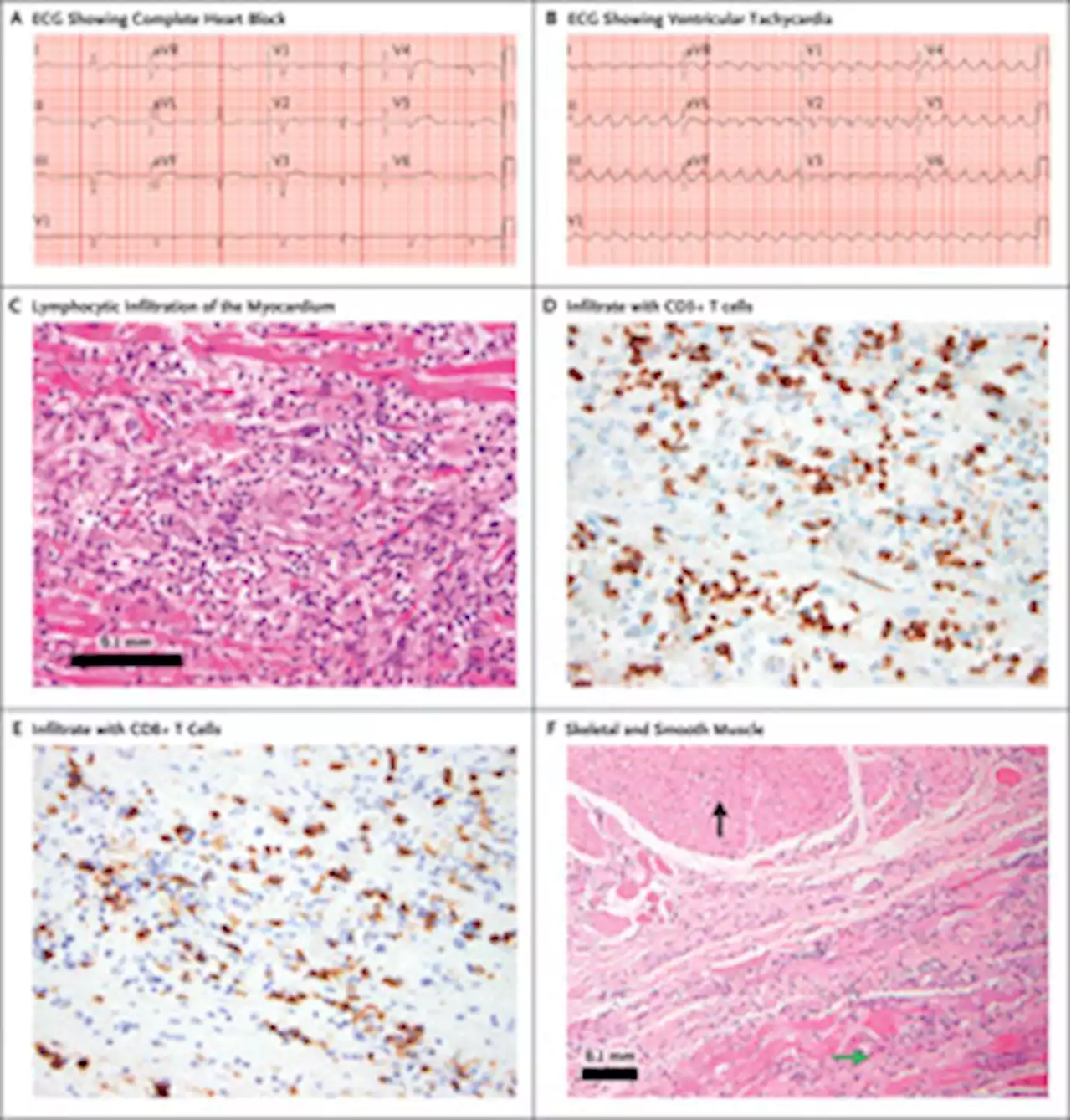 Fulminant Myocarditis with Combination Immune Checkpoint Blockade | NEJM