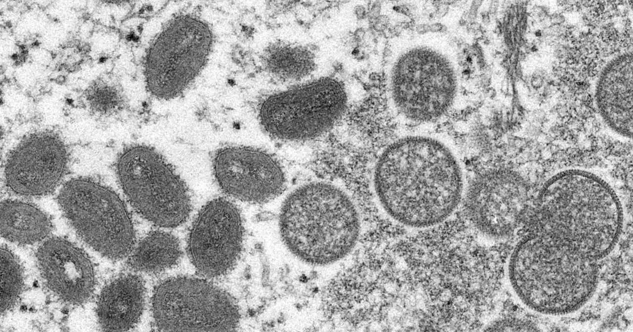 Indiana resident dies, IDOH says monkeypox was a 'contributing factor'