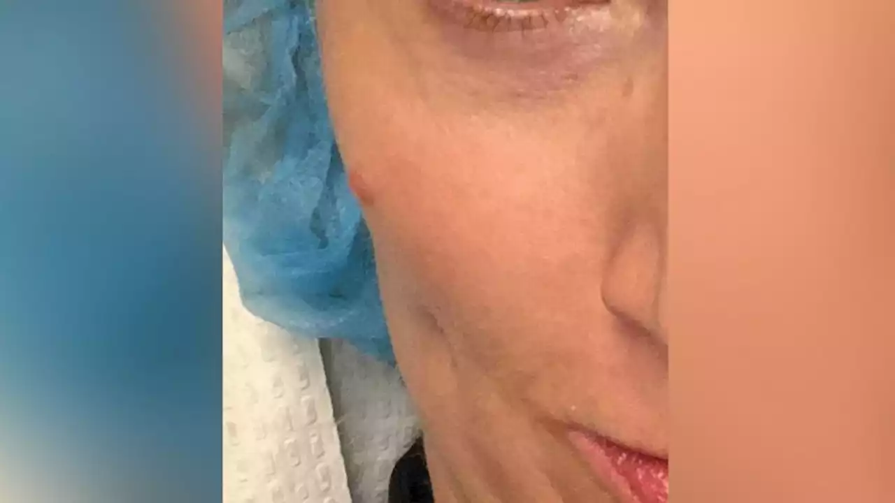 Woman shares warning after mark on face diagnosed as cancerous tumor 2 years later