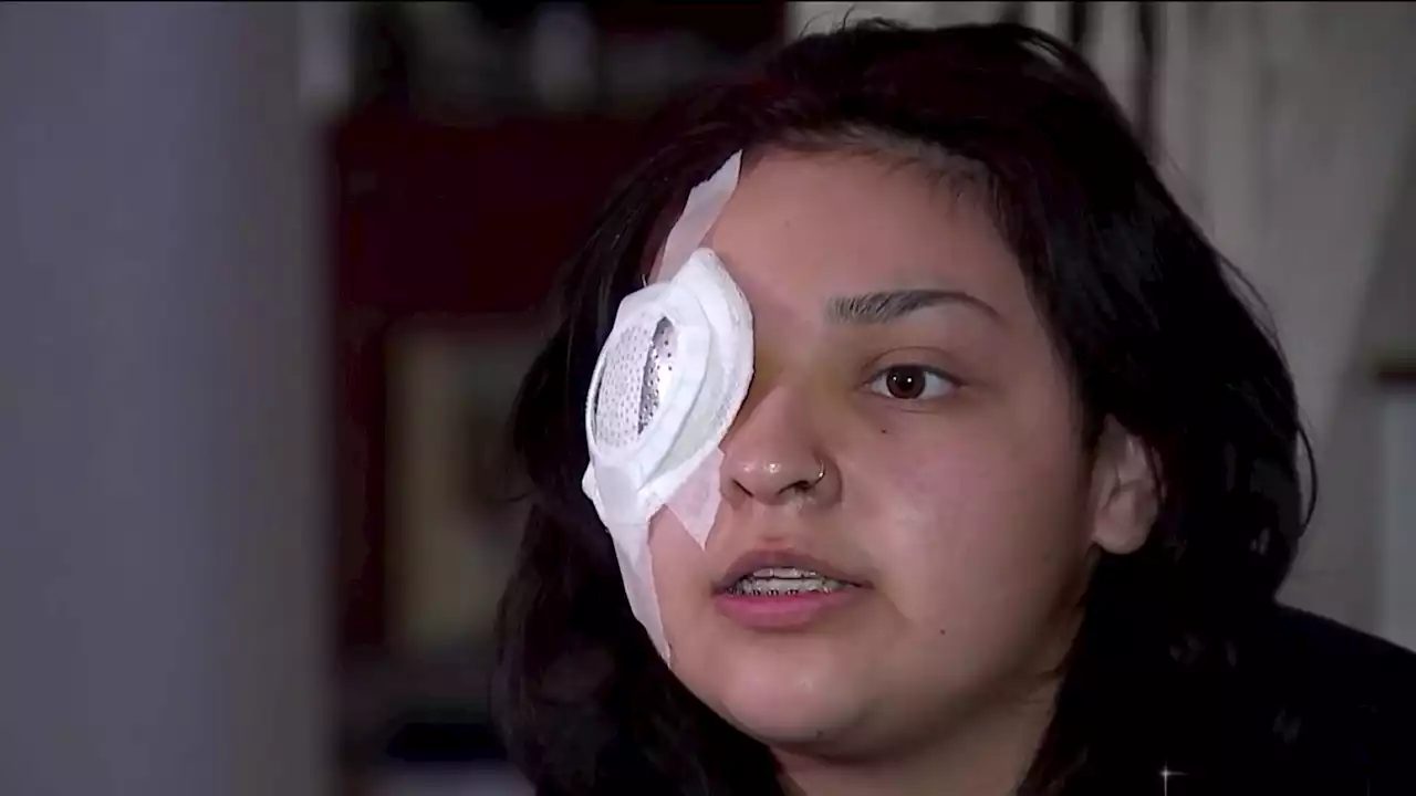 Antioch Fast Food Worker to Lose Eye Following Attack