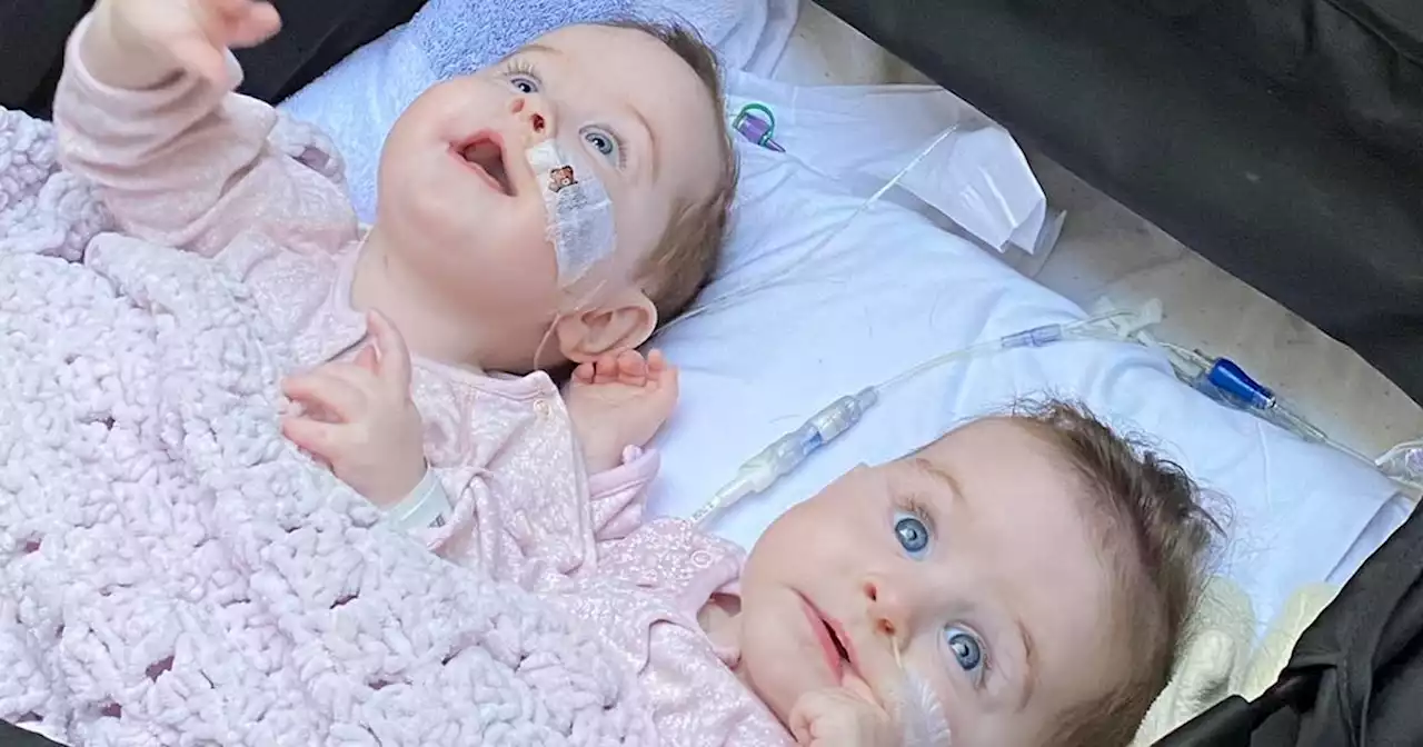 NI parents share photo of formerly conjoined twins after successful surgery