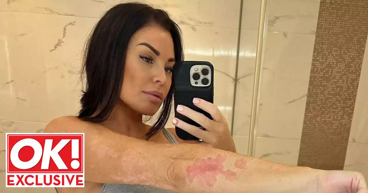 Jess Wright says 'my husband loves me for who I am' amid psoriasis battle