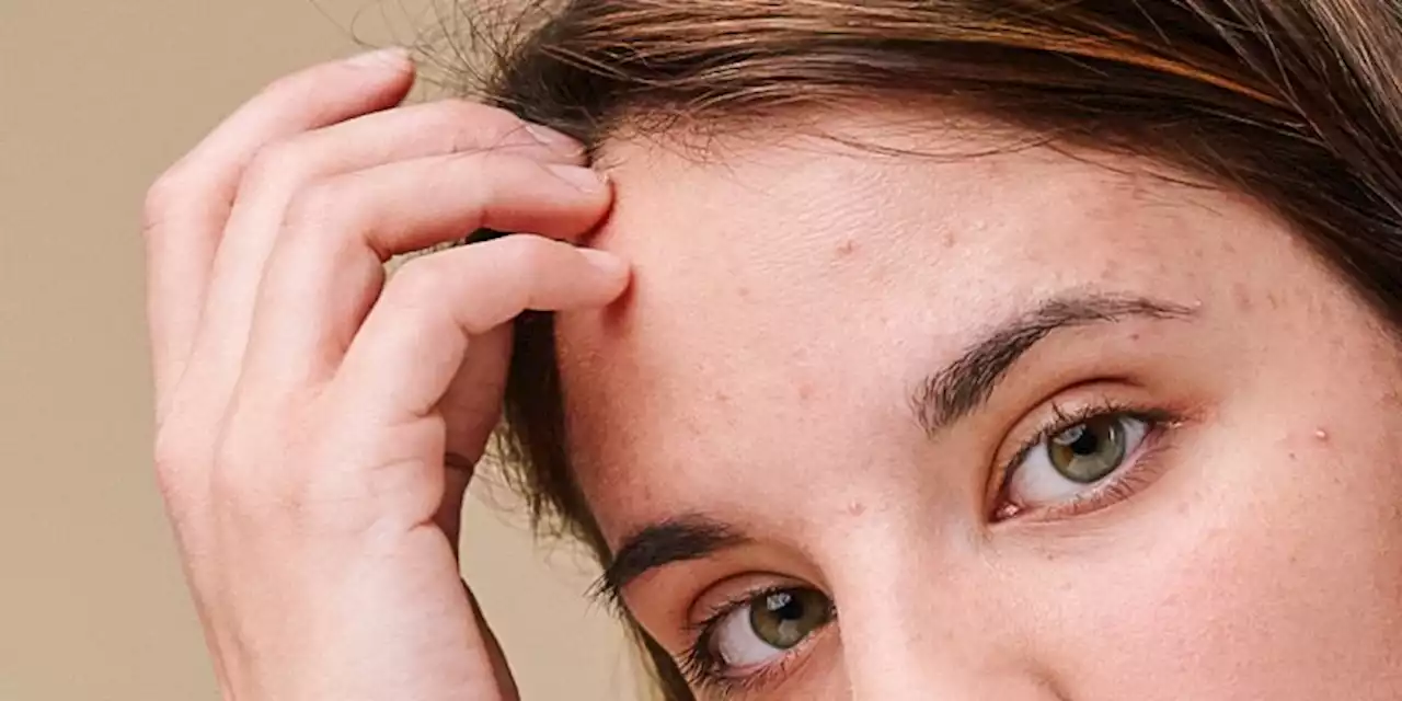 Do You Pick At Your Scalp? Here's What Experts Want You To Know