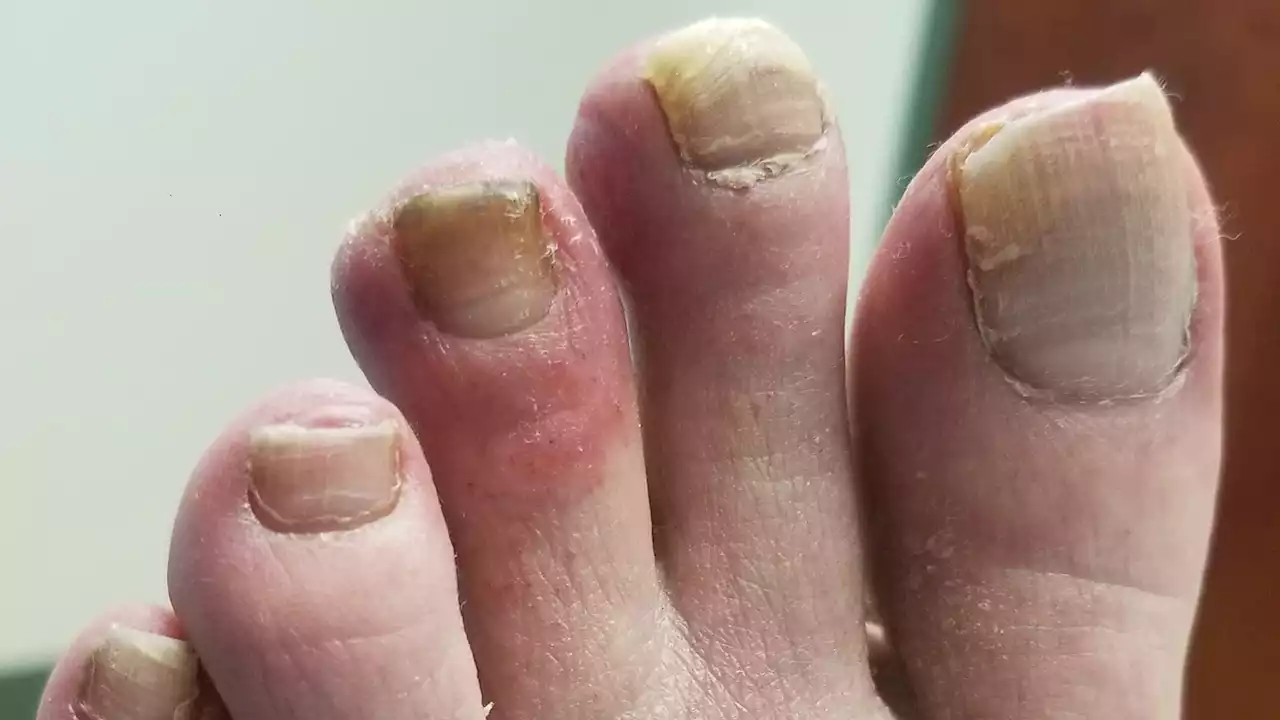 From COVID tongue to COVID toes, the disease may cause weird symptoms