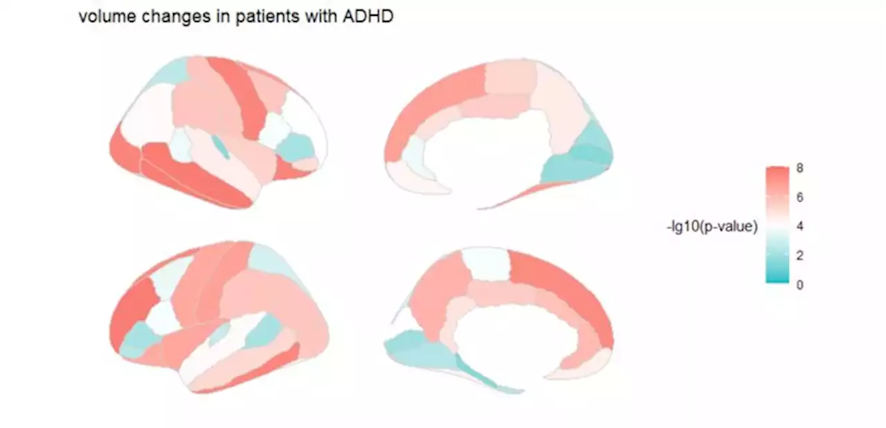 Researchers identify brain markers of ADHD in children