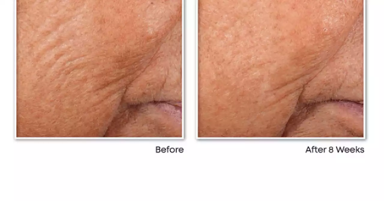 Women say £11 anti-ageing capsules work instantly and 'eradicate lines in weeks'