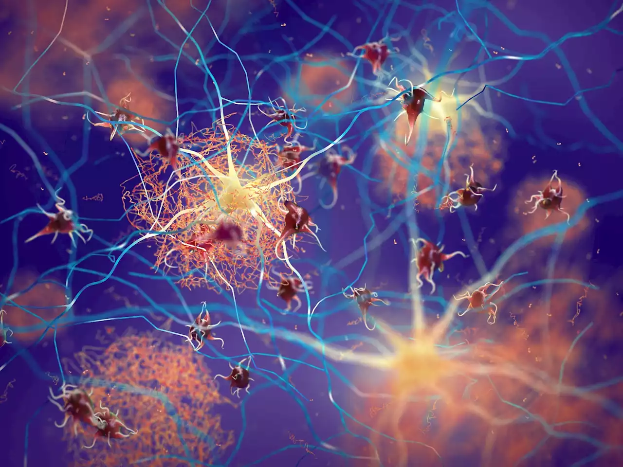 Molecular and cellular similarities identified in the brains of SARS-CoV-2 and Alzheimer's disease patients