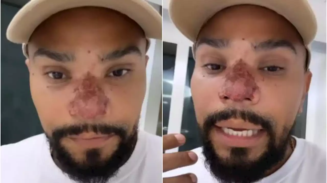 Médico explica problema no nariz de Naldo Benny e alerta para ‘danos irreversíveis’