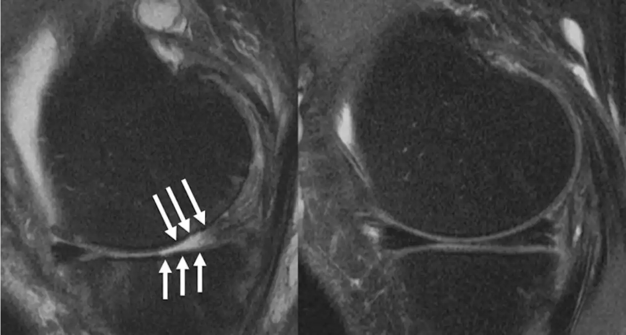 Steroid injections worsen knee arthritis, according to two new studies