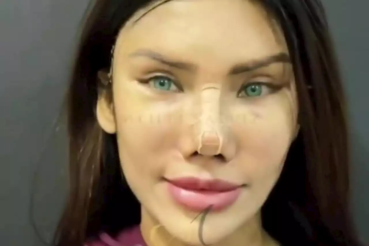 Plastic surgeon shows off the eye lift he's done - but people are mortified