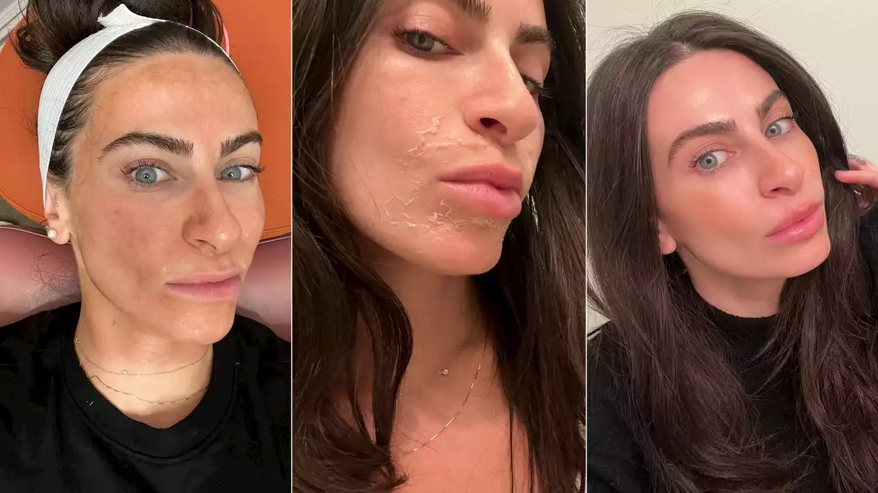 I've Tried Everything to Treat My Melasma. This Peel Actually Worked.