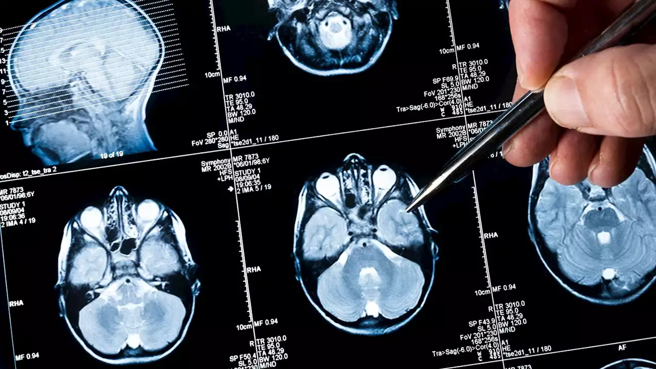 A breakthrough in the treatment of Alzheimer's: A new drug slows cognitive decline