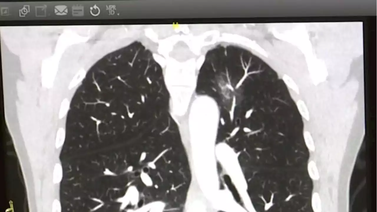 Houston area doctor implements lung cancer screening program to help bring statistics down