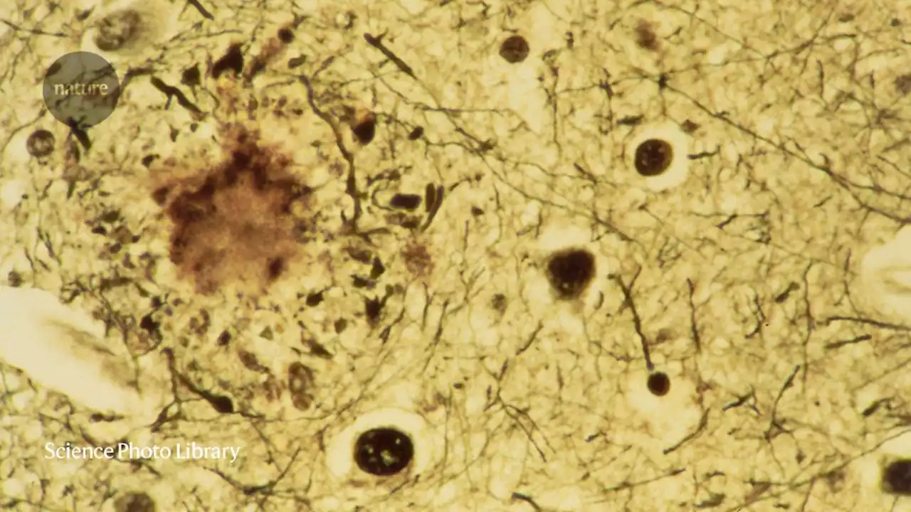 Alzheimer’s drug slows mental decline in trial — but is it a breakthrough?