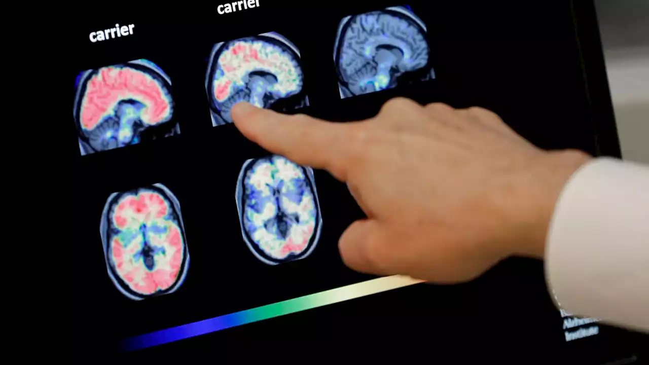 Lecanemab: New Alzheimer's drug slows decline in memory - fuelling hope doctors will one day cure dementia