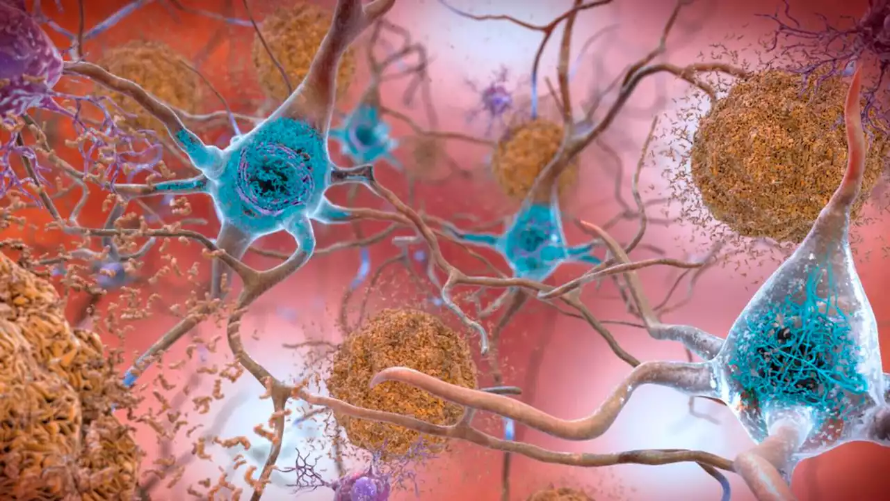 Promising drug slows Alzheimer's, but can it make a real difference?