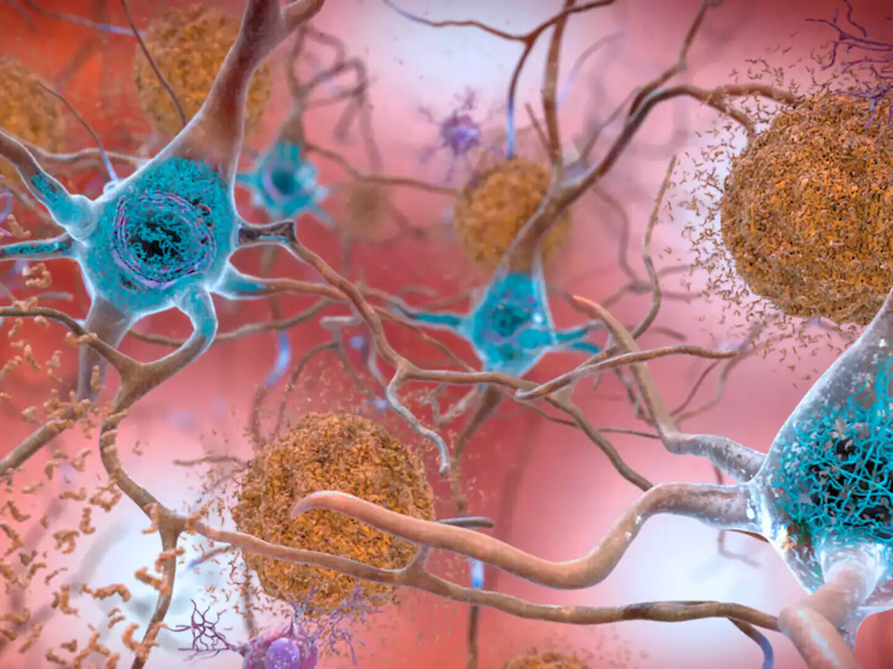 Study: Alzheimer's drug shows modest success slowing declines in memory, thinking