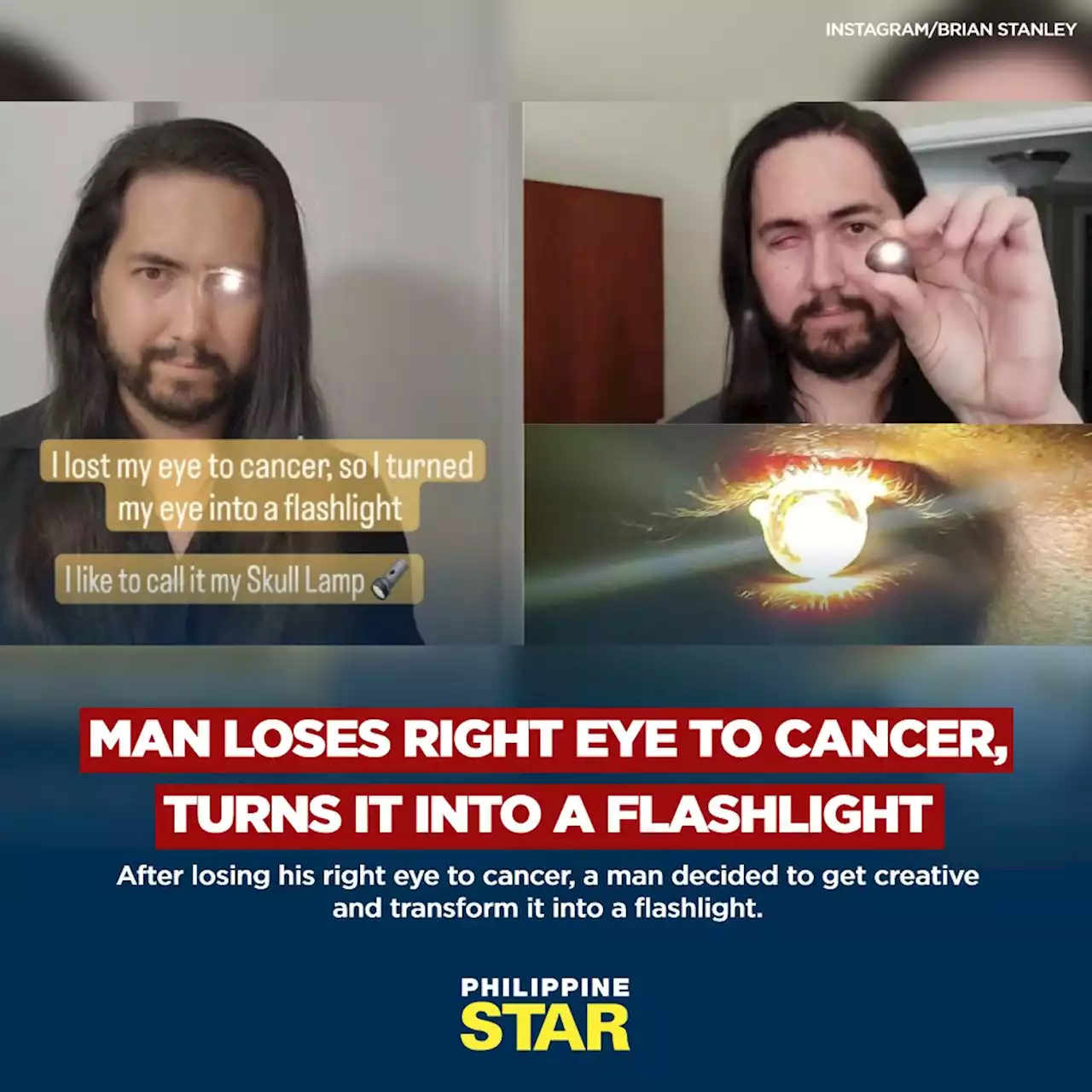 LOOK: Man loses right eye to cancer, turns it into a flashlight