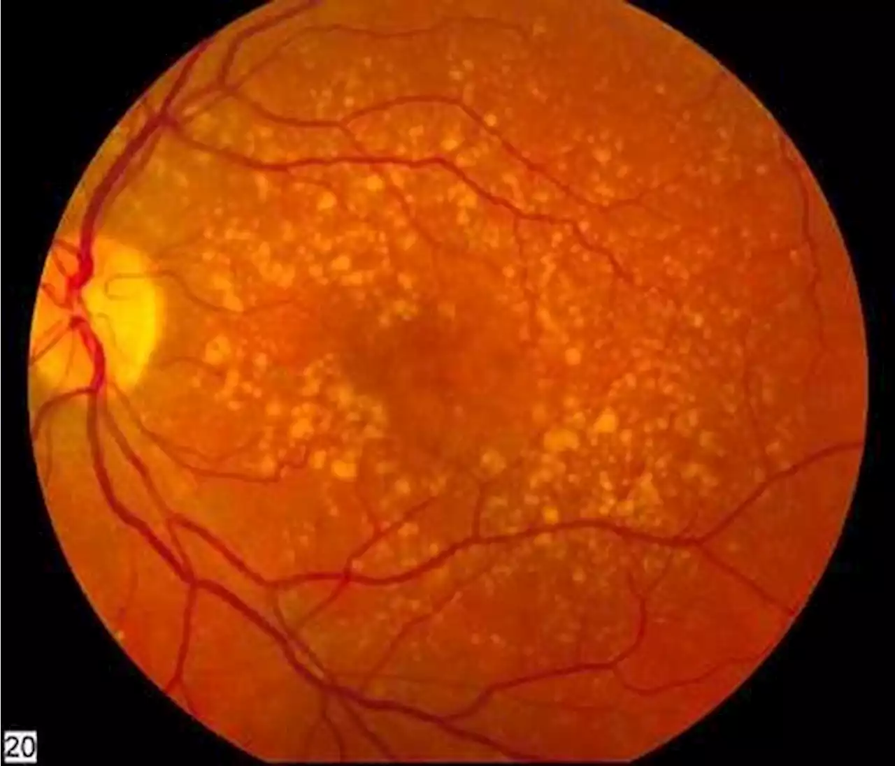 Cholesterol and diabetes drugs may lessen risk of degenerative eye disease associated with aging