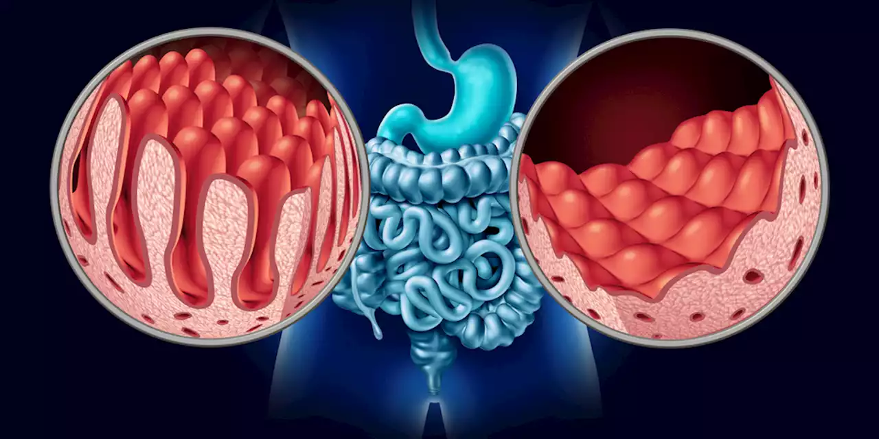 Pediatric Celiac Disease Incidence Varies Across US, Europe