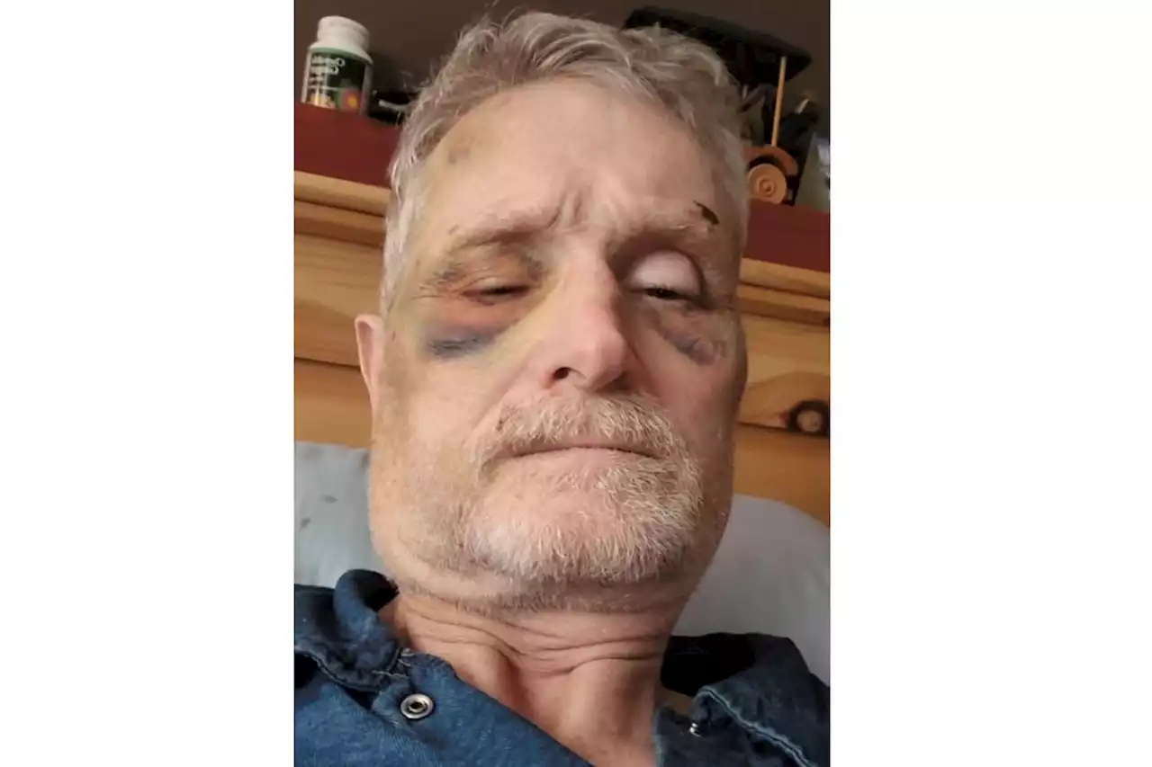 VIDEO: B.C. man posts video of bruised face, alleges assault by police officer - Terrace Standard