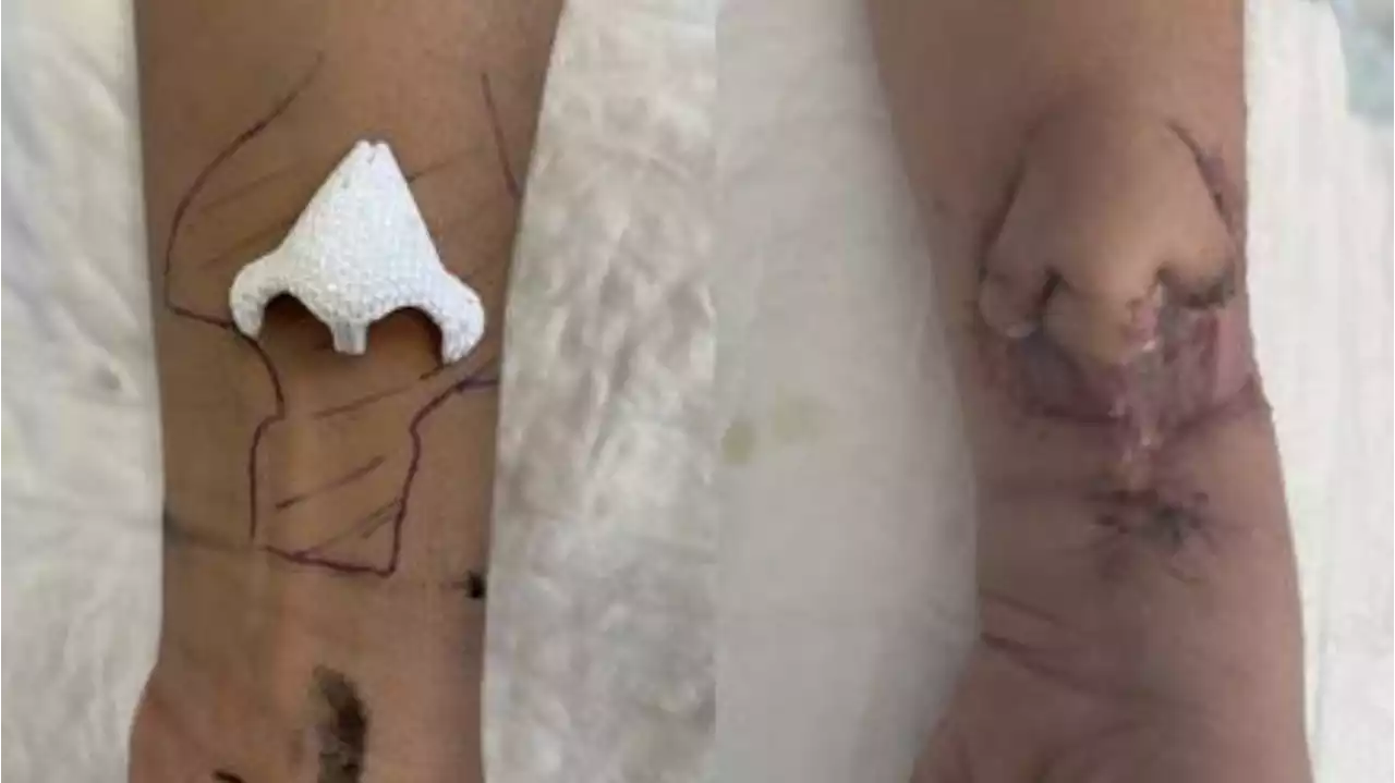 Woman has nose grown on her arm before having it successfully transplanted onto her face