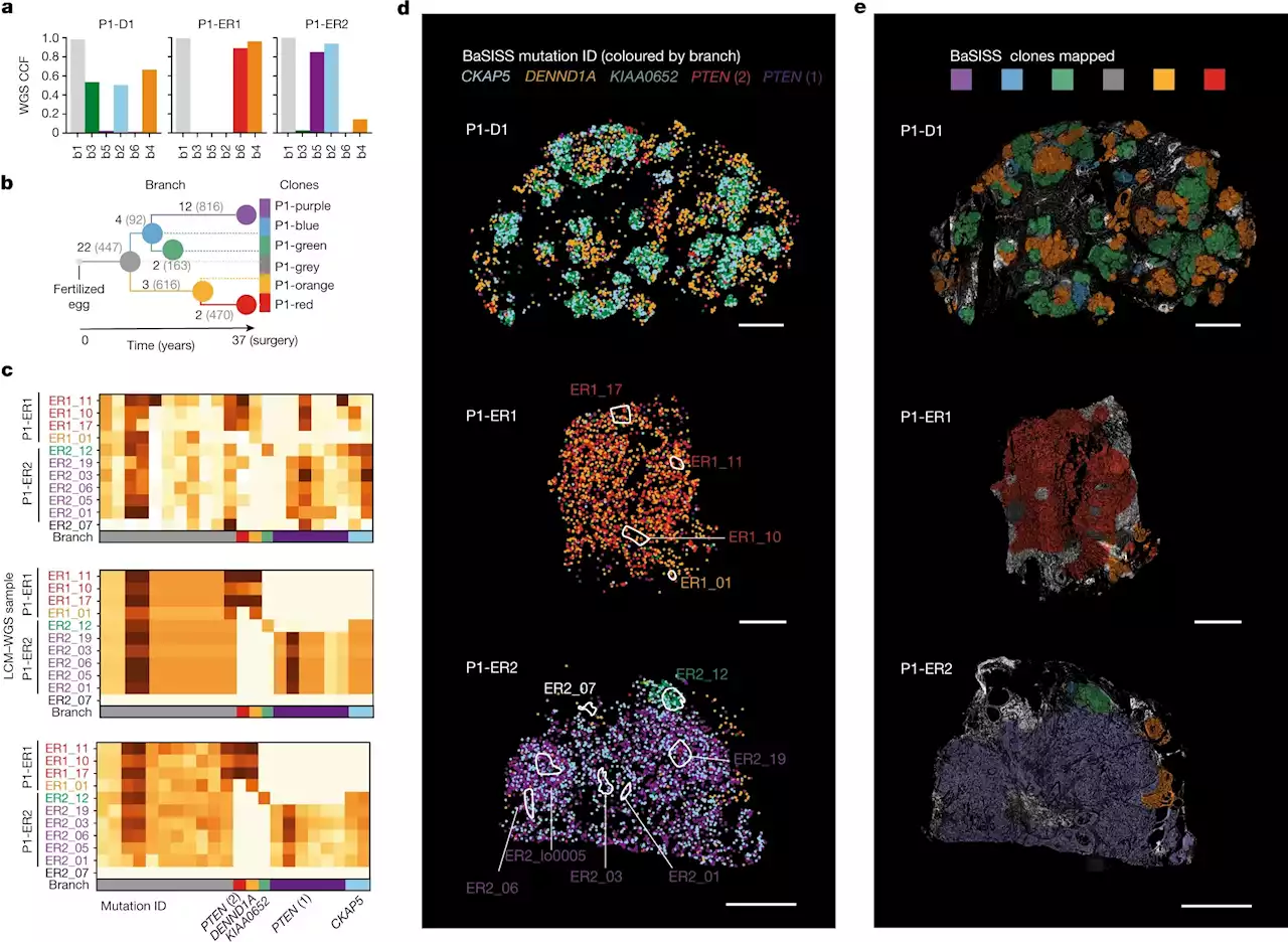 Breast cancer spread uncovered by new molecular microscopy