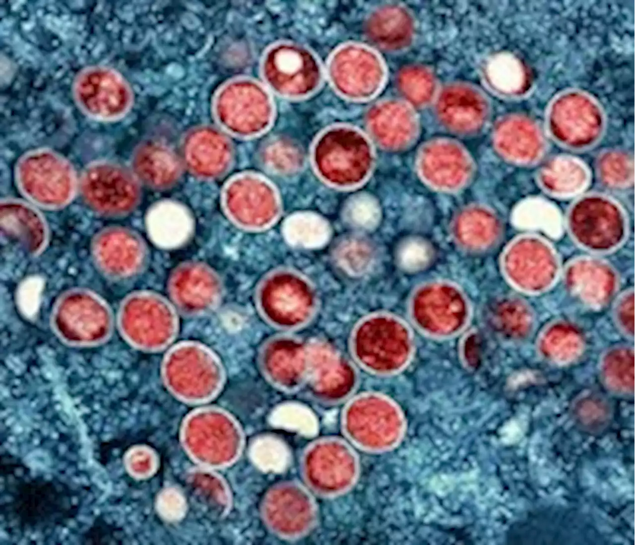 Virginia reports first monkeypox death