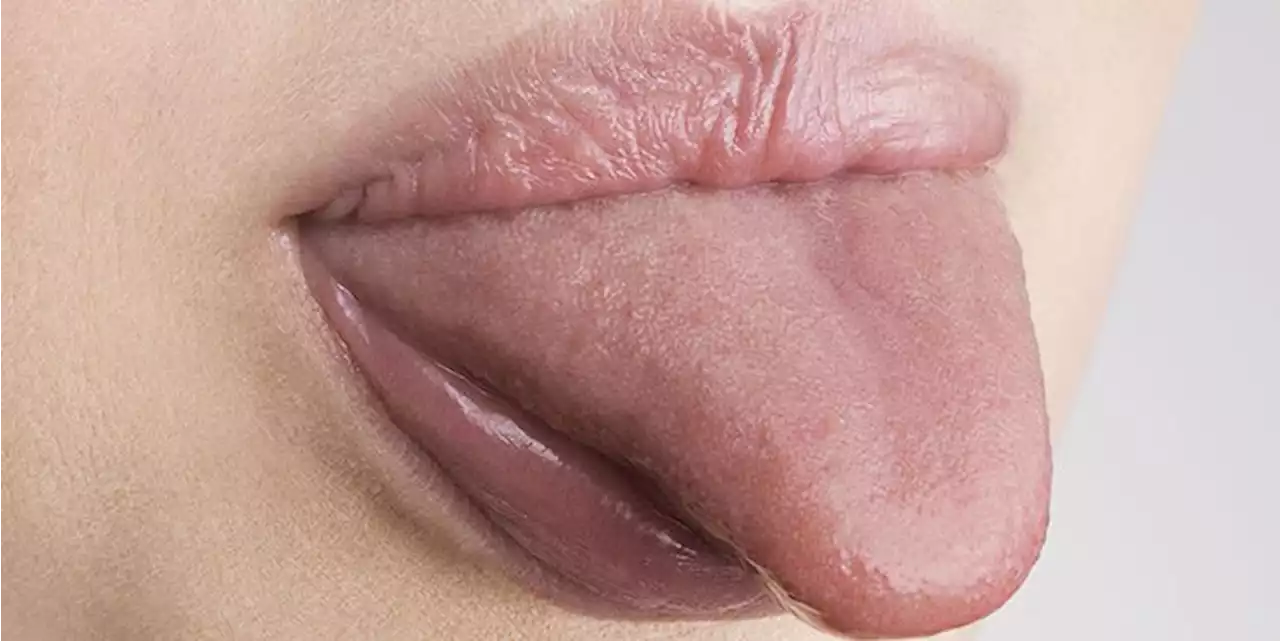 Wondering Why Your Tongue Is White? Let the Experts Explain