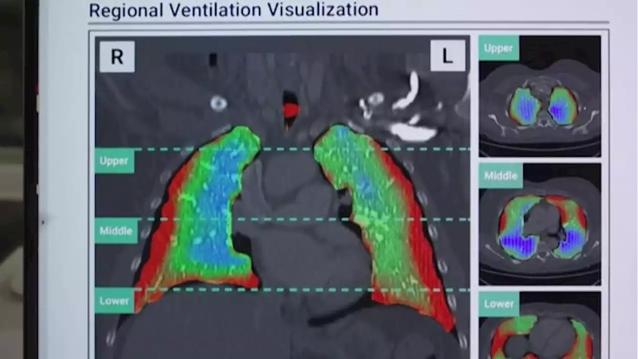 World’s first 4D scan of long COVID lungs changing how doctors diagnose, treat virus