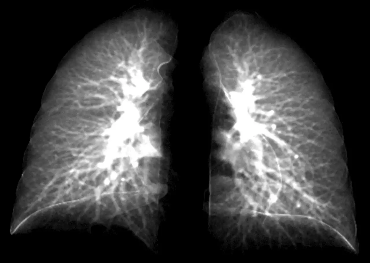 Long-COVID’s Effects Can Now Be Detected Using Simple Chest X-Rays