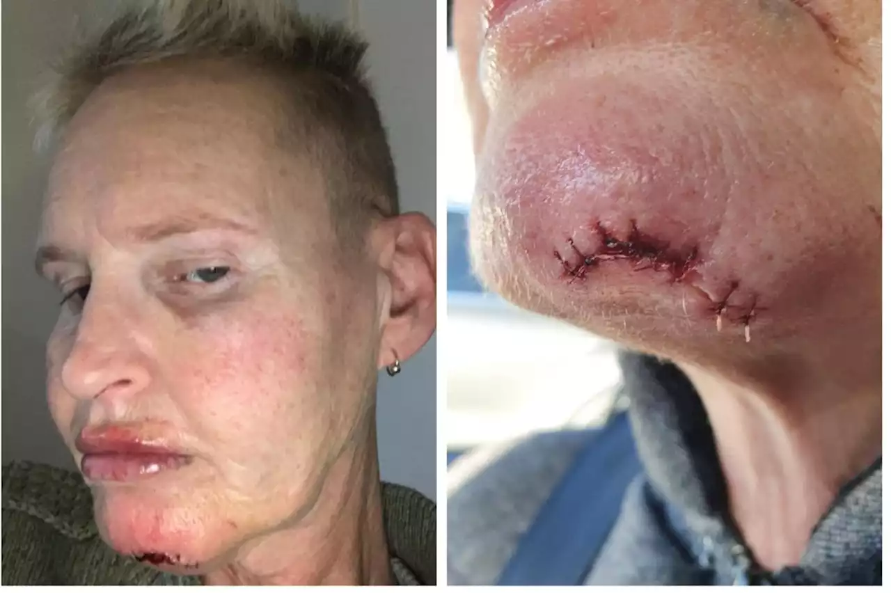 Leeds woman attacked by two men and 'stabbed in the chin' while walking dogs