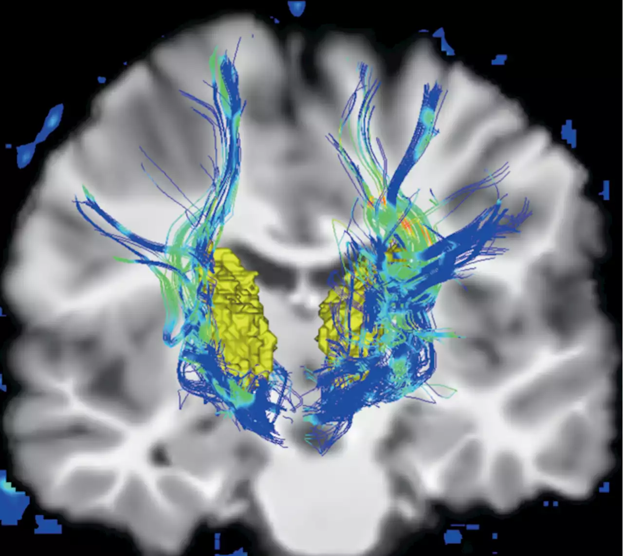 Parkinson’s disease drug hunters think outside the α-synuclein box - Nature Biotechnology