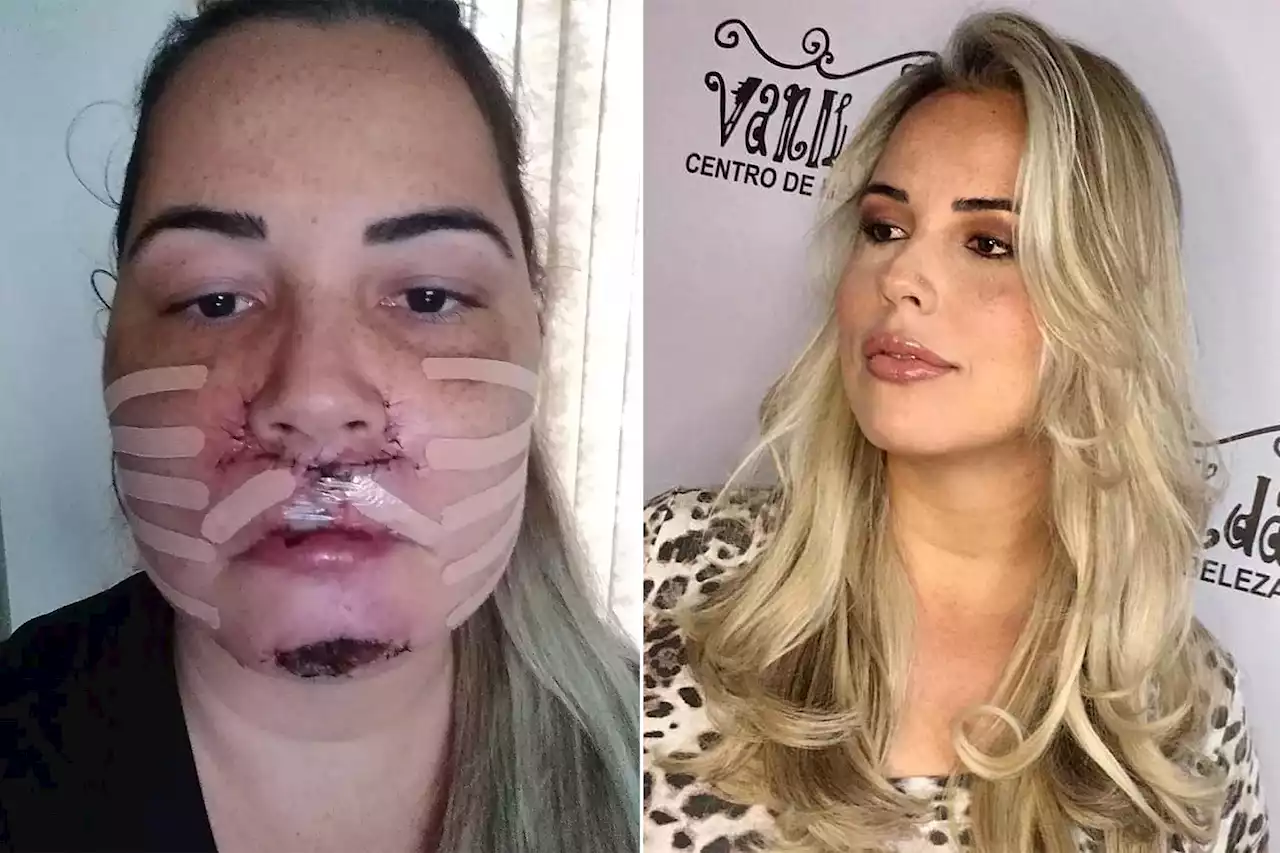 I’m deformed after botched knock-off fillers: ‘I just want my face back’