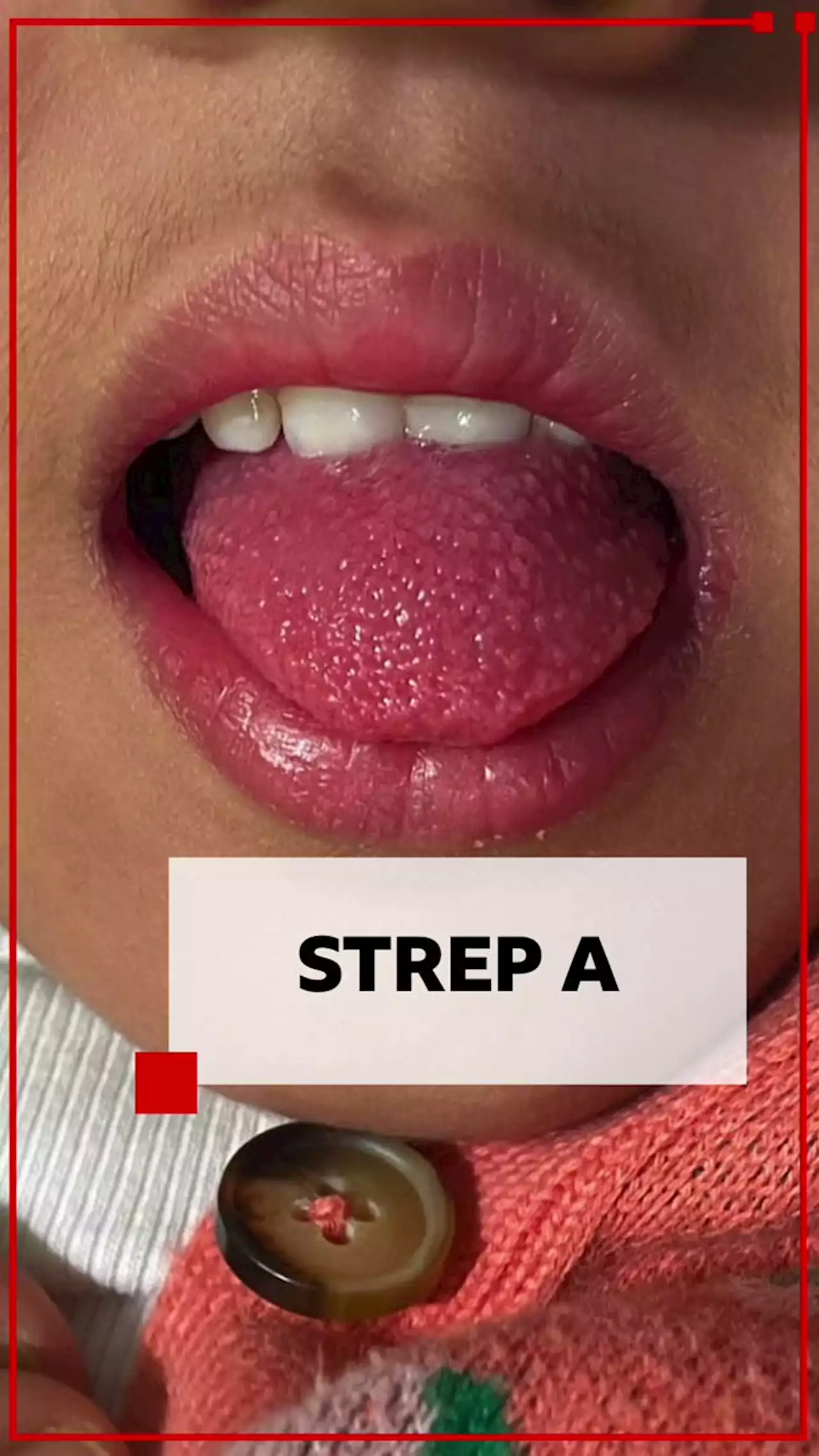 What is strep A and what are the symptoms?