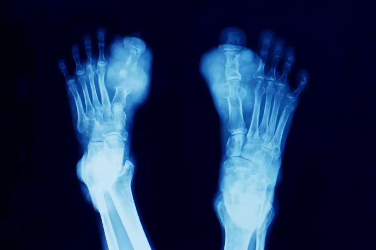 Gout linked to 376 genetic variants in a study of 2.6 million people