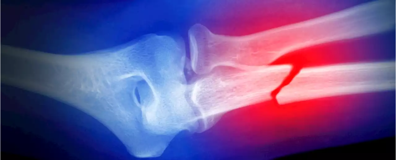 Mysterious Pattern Emerges in The Future of Children Who Break Bones