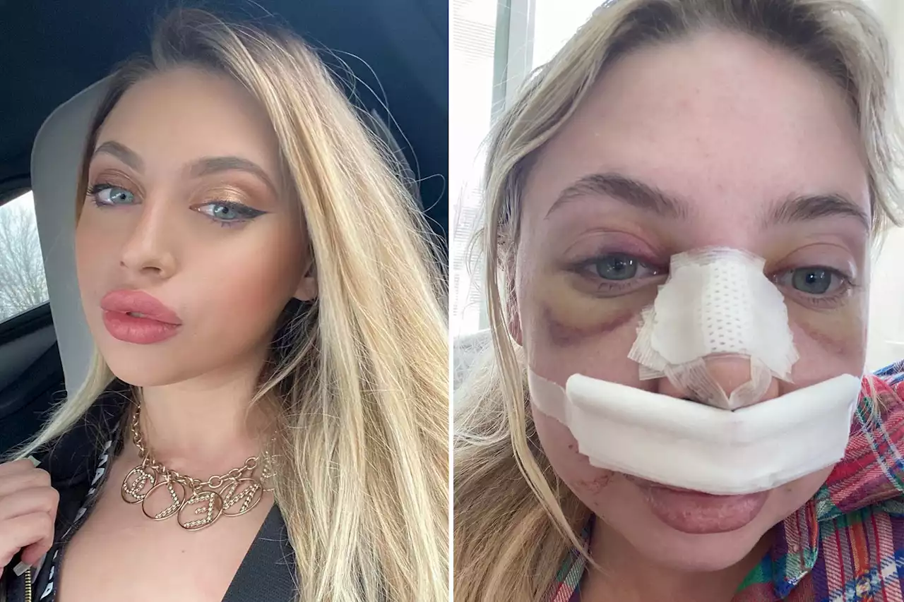 I got a nose job — my mom was shocked by what the doctor found in there