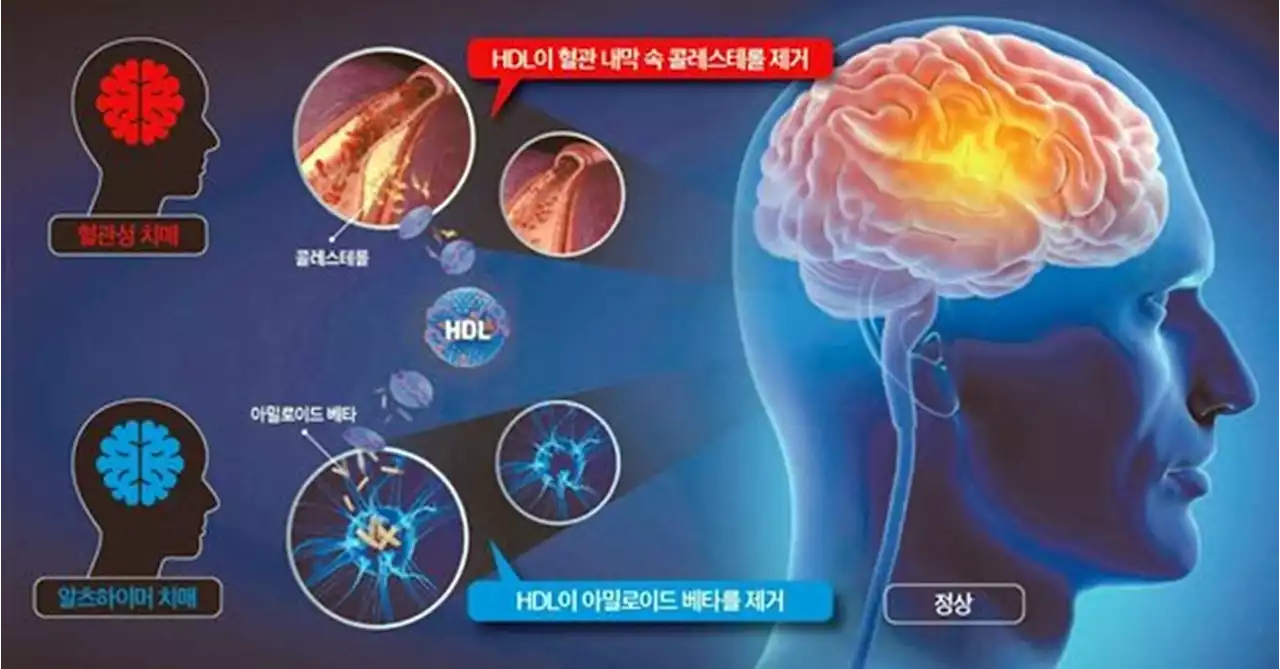 치매환자 분석하니 전조 있었다…고혈압·혈당 그리고 '이것' | 중앙일보