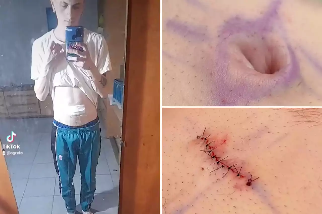 I had my belly button surgically removed — and no one understands why