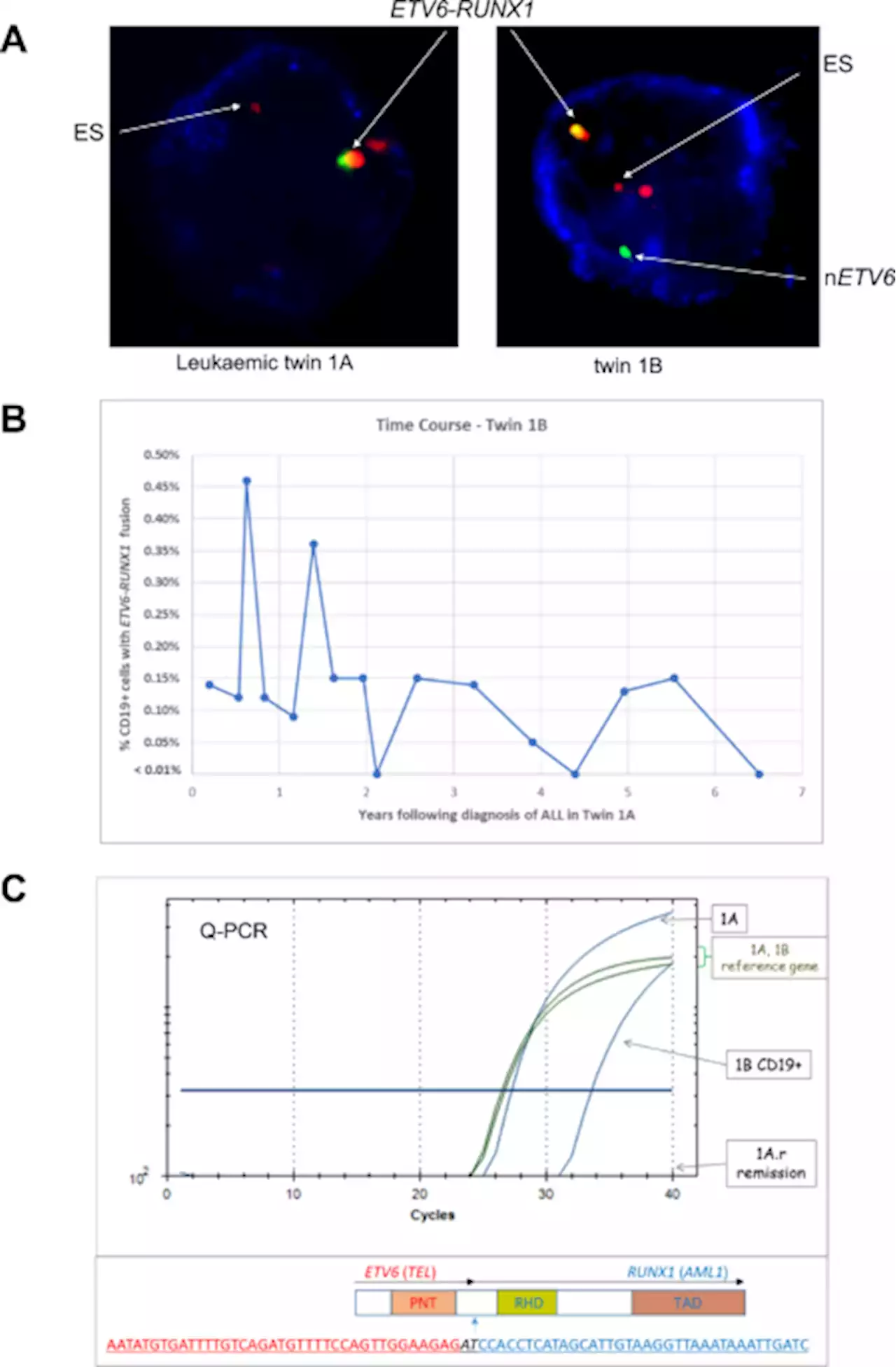 Covert pre-leukaemic clones in healthy co-twins of patients with childhood acute lymphoblastic leukaemia - Leukemia