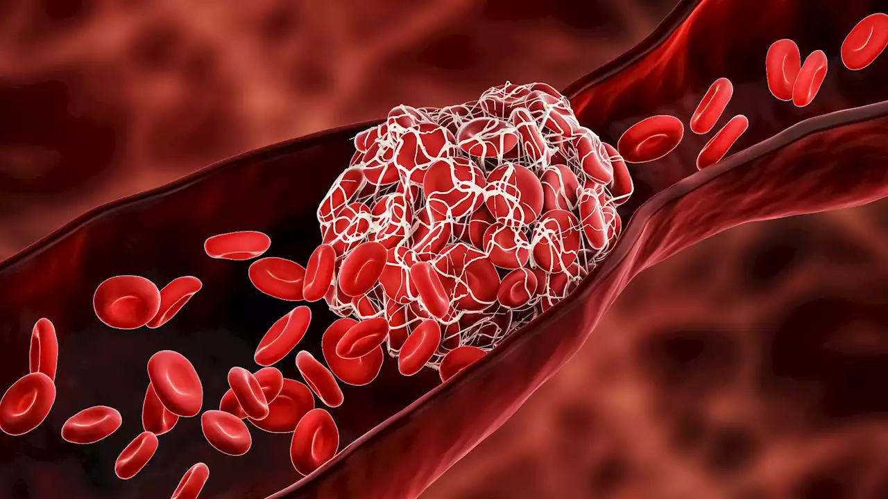 Review on nanoparticles usage for treating thrombosis induced by SARS-CoV-2 infections