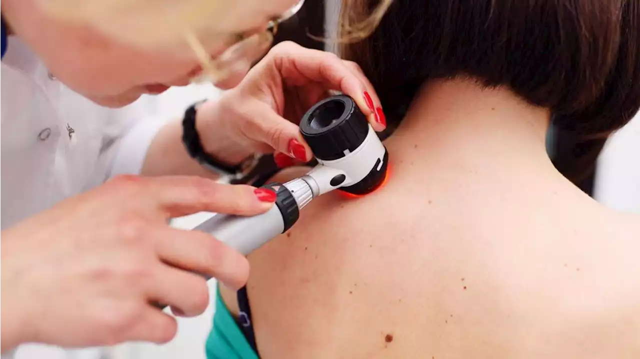 Melanoma, uno de los tipos de cáncer de piel más común