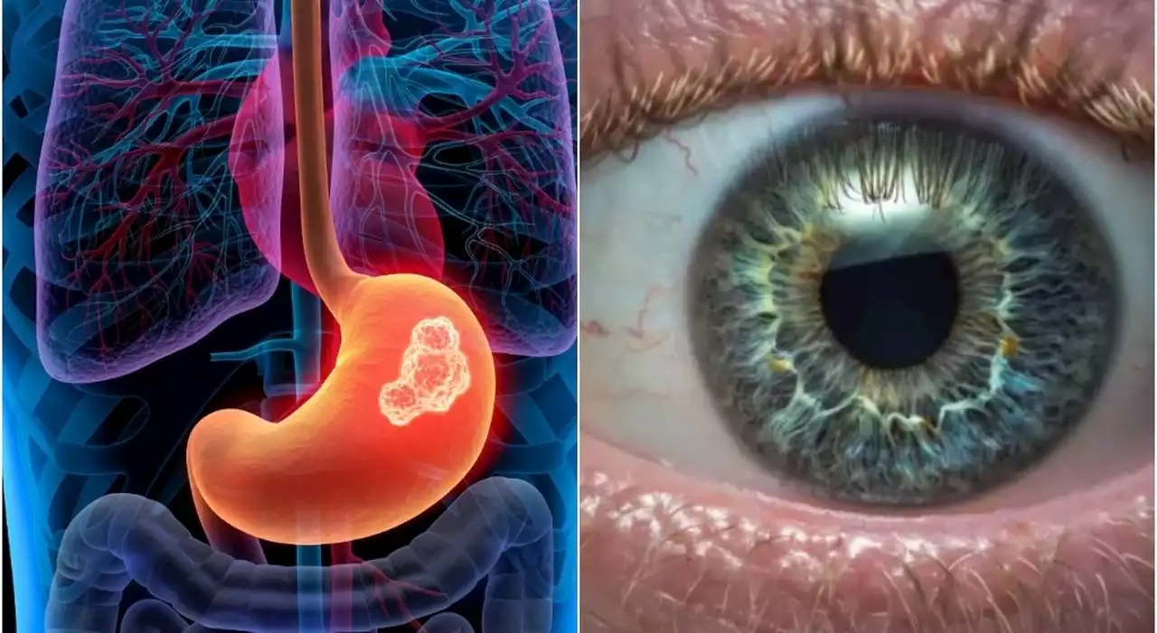 Tumore allo stomaco, scoperto un nuovo sintomo che permette di riconoscerlo dall'occhio