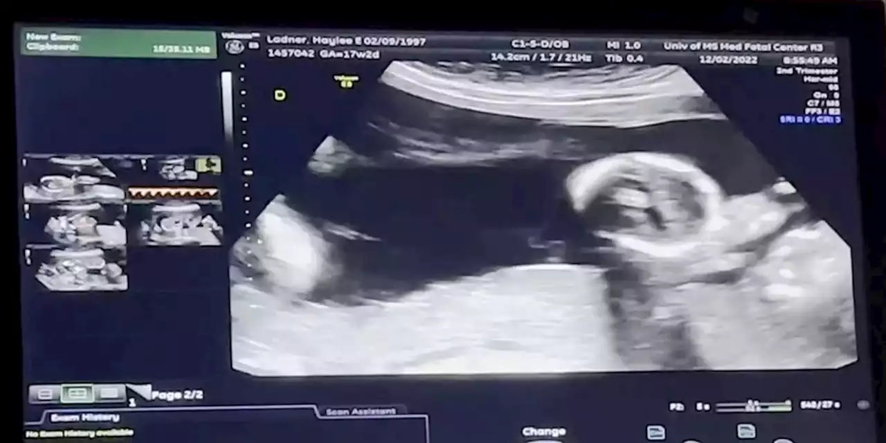 Teacher surprised to find out she is pregnant with quintuplets: ‘How is this possible?’