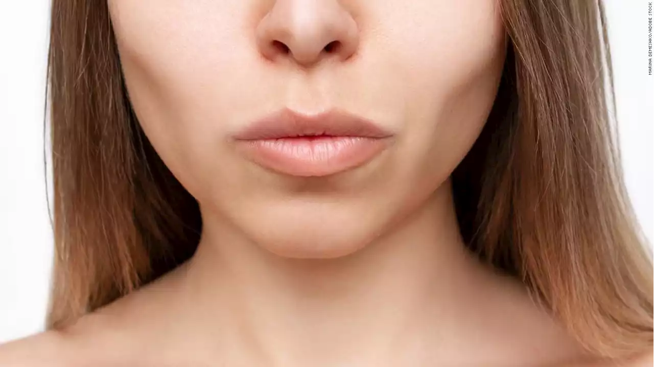 Why everyone is suddenly talking about buccal fat removal